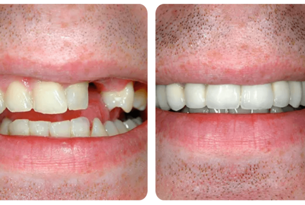before and after cosmetic dentistry in santa barbara