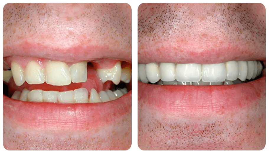 before and after cosmetic dentistry in santa barbara