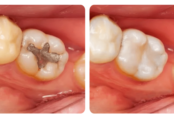 before and after cosmetic dentistry in santa barbara