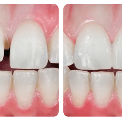 before and after cosmetic dentistry in santa barbara