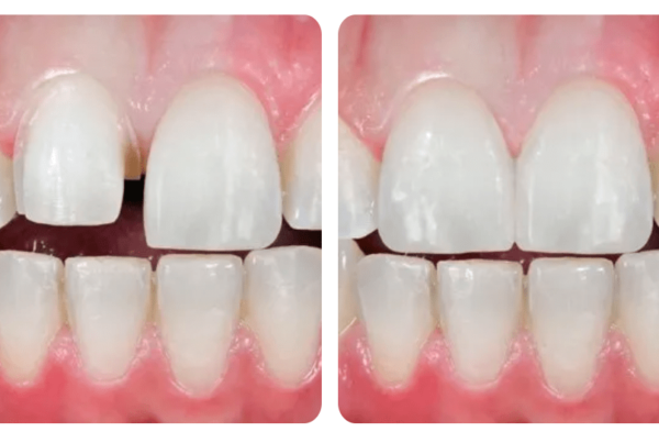before and after cosmetic dentistry in santa barbara