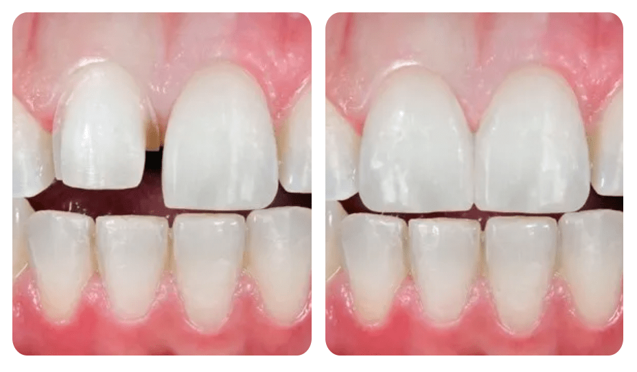 before and after cosmetic dentistry in santa barbara