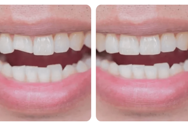 before and after cosmetic dentistry in santa barbara