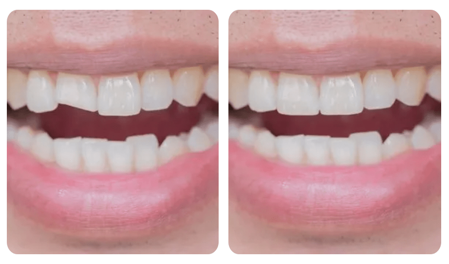 before and after cosmetic dentistry in santa barbara
