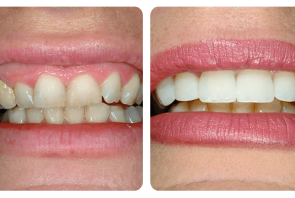 before and after cosmetic dentistry in santa barbara