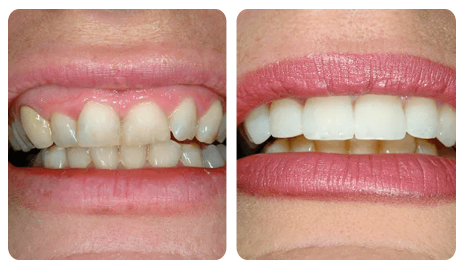 before and after cosmetic dentistry in santa barbara