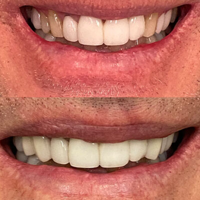 dental-veneers-2