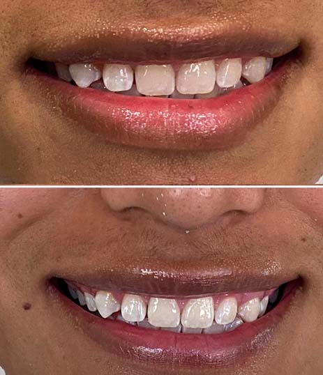 patient results from Zoom teeth whitening at Riviera Smiles in Santa Barbara, CA