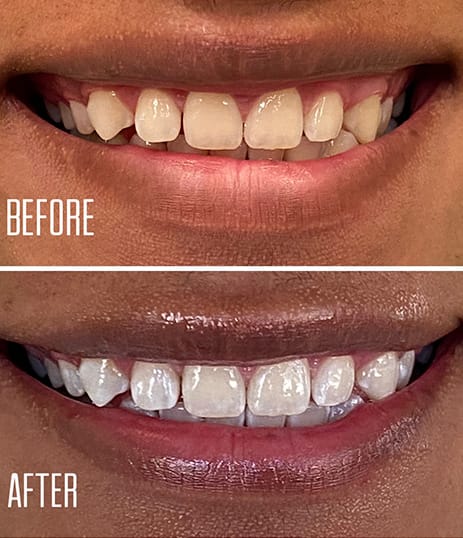 patient results from teeth whitening in Santa Barbara, CA