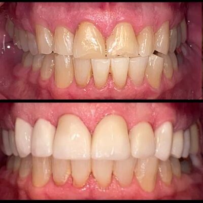 veneers-2