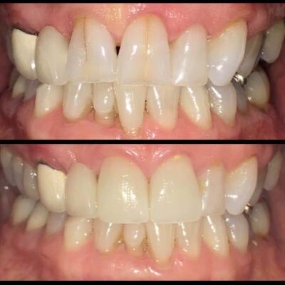 veneers-4